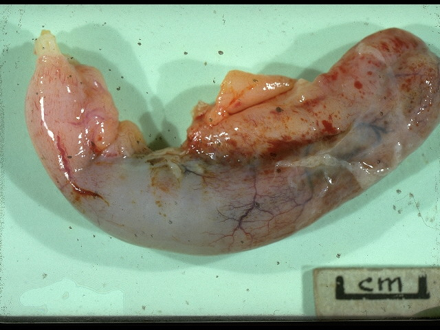 surgically removed inflamed appendix 